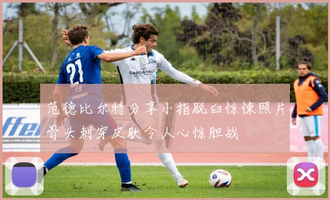 范德比尔特分享小指脱臼惊悚照片骨头刺穿皮肤令人心惊胆战